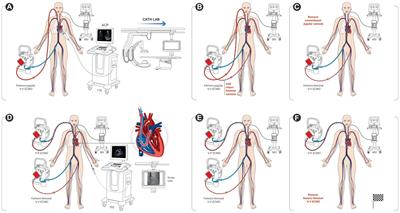 Refractory cor pulmonale under extracorporeal membrane oxygenation for acute respiratory distress syndrome: the role of conversion to veno-pulmonary arterial assist—a case series